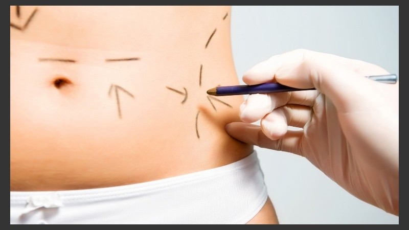 La abdominoplastia consigue un abdomen más plano, más firme y una reducción de la cintura.
