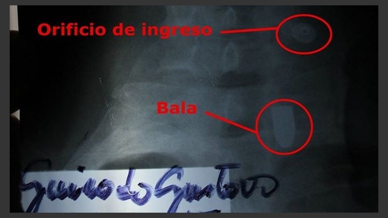 Una radiografía muestra dónde se alojó la bala.
