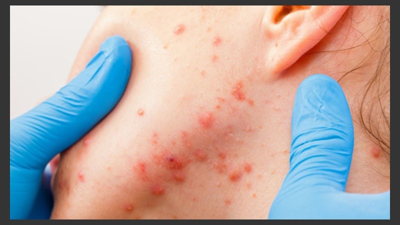Identificada la causa que genera el acné, hay diversos tratamientos específicos para combatirlo.