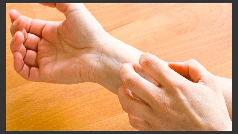 Se pueden prevenir algunos tipos de eccema evitando los irritantes, el estrés y las cosas que provocan alergia.