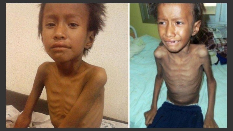 La desnutrición crónica de Néstor precipitó el fatal desenlace. 