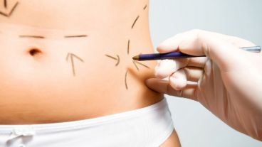 La abdominoplastia consigue un abdomen más plano, más firme y una reducción de la cintura.