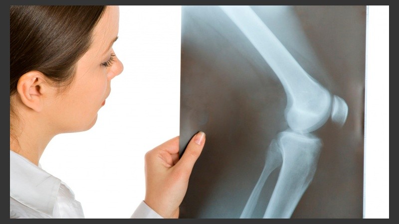 Cuando un individuo tiene osteopetrosis, todos sus huesos están afectados, son extremadamente densos y su esqueleto es extremadamente pesado.
