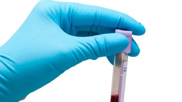 El SXF se puede diagnosticar mediante una prueba de ADN que se realiza en una muestra de sangre.