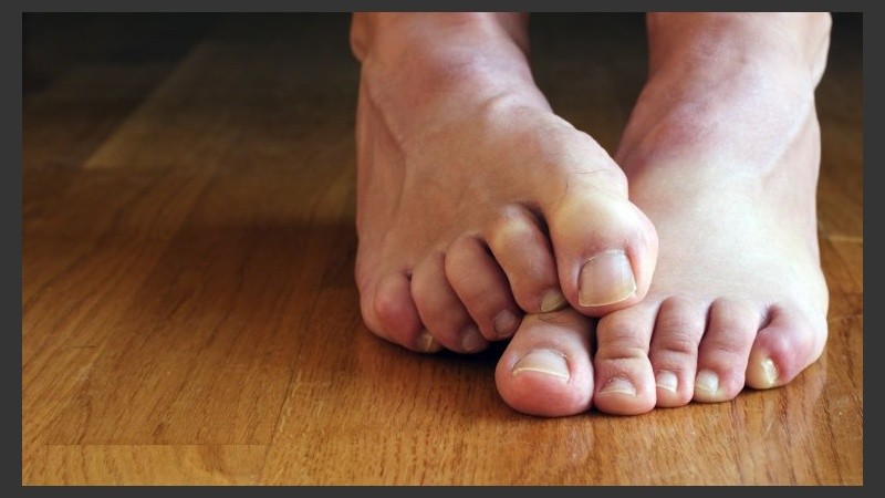 La gota se manifiesta con ataques de inflamación aguda muy dolorosos acompañados de enrojecimiento de la piel.