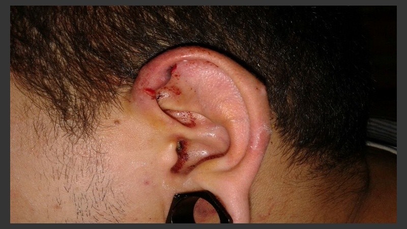 La herida en la oreja del joven agredido.