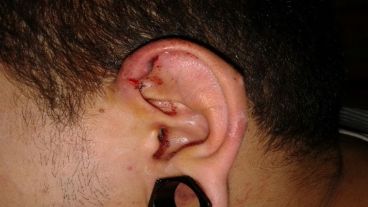 La herida en la oreja del joven agredido.