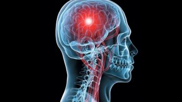 Hay dos tipos de ataques cerebrales: el isquémico o infarto cerebral y la hemorragia cerebral.