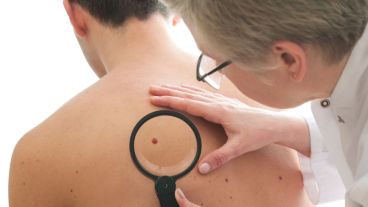 El 92 % de los pacientes logra resolver el cáncer de piel con este tipo de tratamiento no invasivo.