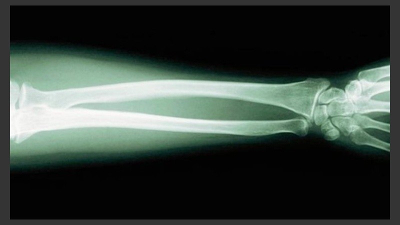 El osteosarcoma es un tipo de cáncer óseo que afecta sobre todo a varones con edades comprendidas entre los 10 y los 30 años.