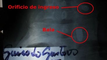 Una radiografía muestra dónde se alojó la bala.