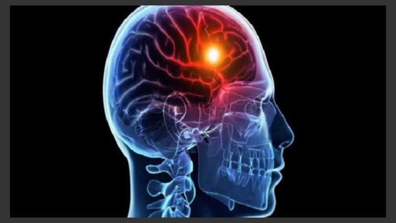 Existen dos tipos de ACV: el isquémicoel y el hemorrágico.