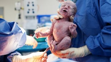 Los médicos sacaron un solo bebé del vientre de la mamá.