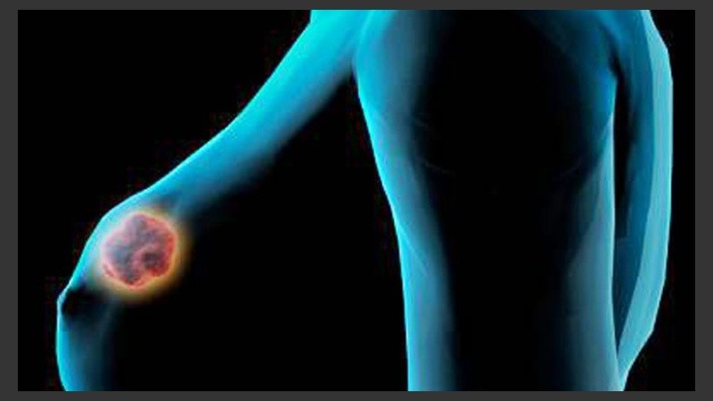 Las mujeres con una densidad mamaria extrema tienen una probabilidad hasta seis veces mayor de padecer este tipo de tumor.
