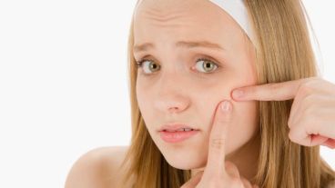 El acné tiene grandes consecuencias sobre el bienestar psicológico y la calidad de vida de quien lo padece.
