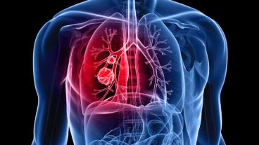 El cáncer de pulmón es responsable de la mayoría de muertes por cáncer en hombres.