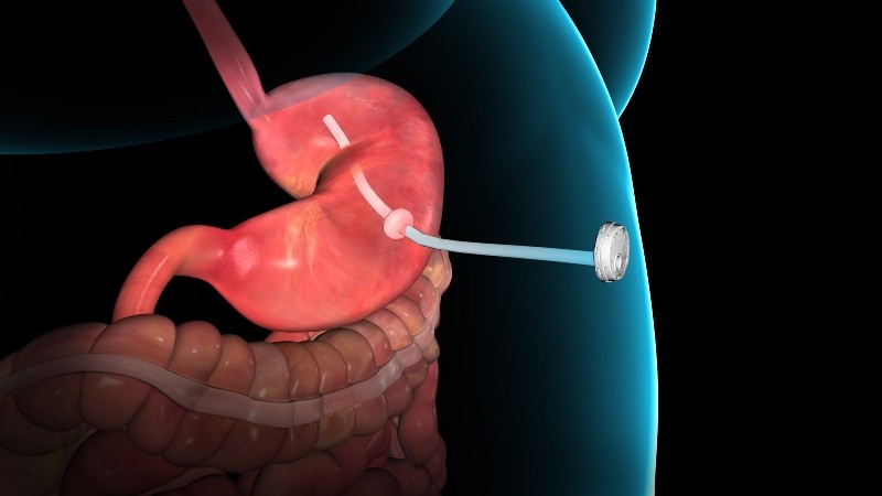 Consigue que un porcentaje de la comida no sea absorbida para facilitar la pérdida de peso.