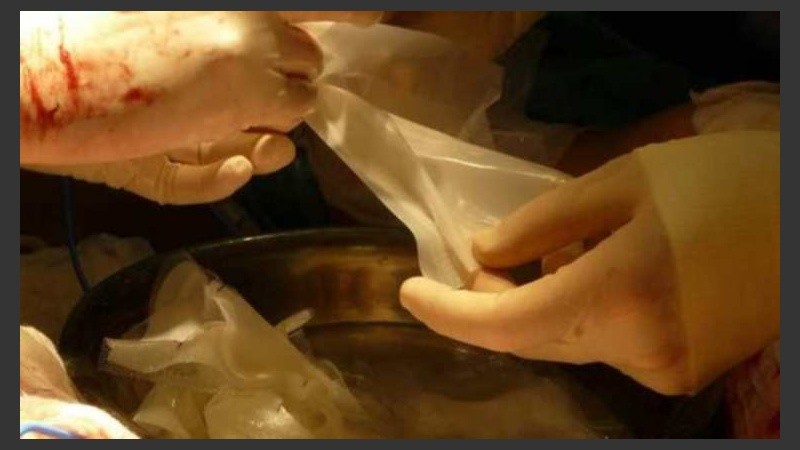 La paciente, de 29 años, tenía quemaduras en el 70% del cuerpo y ahora evoluciona favorablemente.