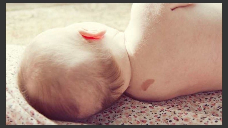 Existen varios tratamientos: la cortisona, la aplicación de láser y nitrógeno líquido.