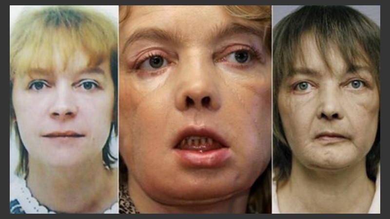 Dinoire fue atacada por su perro labrador en el rostro, lo que le provocó serias y profundas heridas.