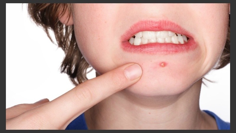 El problema de explotarlos es que pueden aumentar la infección y la inflamación.