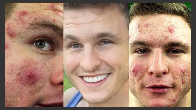 Turner dixit: “Si tienes acné, eliminá todos los lácteos de tu dieta, tomá al menos tres litros de agua al día, y comé entre 10 y 16 porciones de vegetales diarias