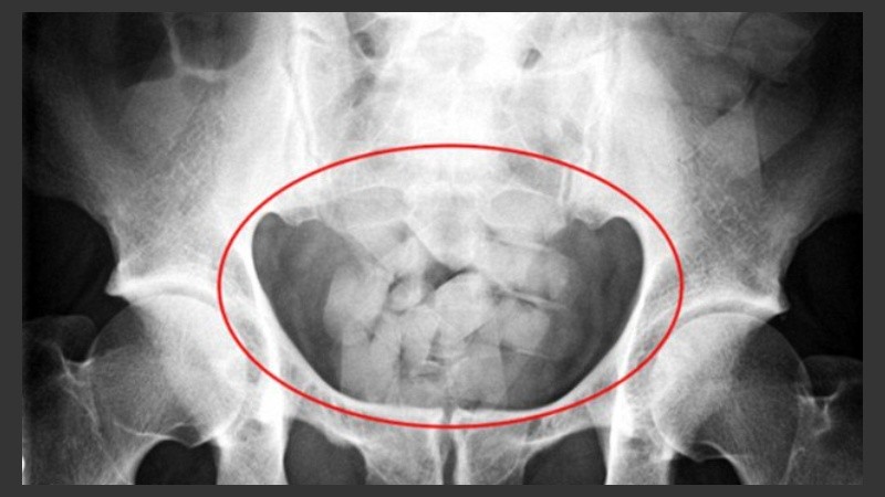 Las cápsulas se detectan a través de tomografías computadas.