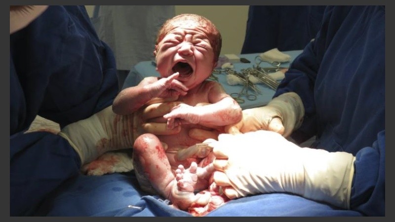 Aquellos niños que no transitan el canal vaginal tienen el doble de riesgo de desarrollar ese tipo de alergia.