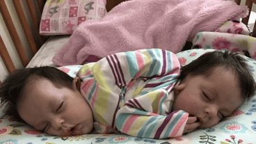 Las siamesas no será separadas por consejo médico.