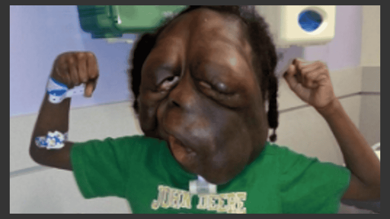 Amara Stover padece neurofibromatosis 