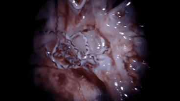 El Angiostrongylus cantonensis afecta al sistema nervioso central.
