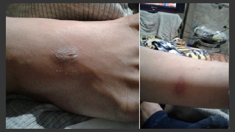 Lesiones en pie y pierna de uno de los adolescentes internado en San Camilo.