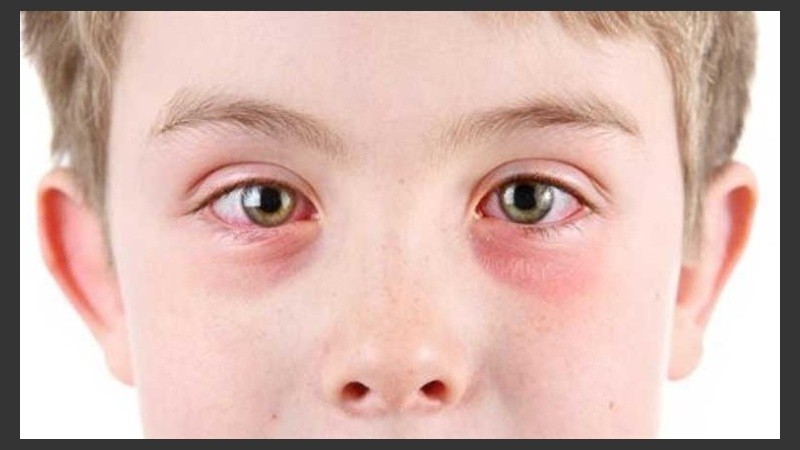 Muchas veces los síntomas se asemejan a las conjuntivitis infecciosas.