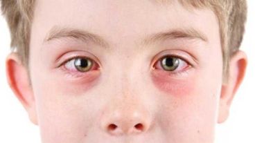 Muchas veces los síntomas se asemejan a las conjuntivitis infecciosas.