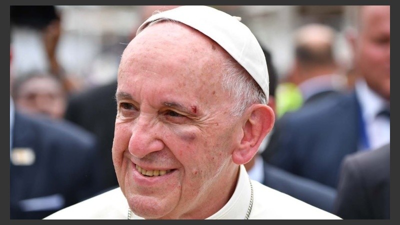 Así quedó el rostro del Papa Francisco luego del golpe. 