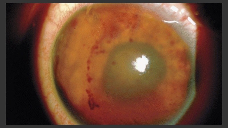 Para la extracción, el insecto, de tres milímetros, tuvo que ser cortado en trozos más pequeños.