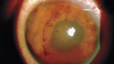 Para la extracción, el insecto, de tres milímetros, tuvo que ser cortado en trozos más pequeños.