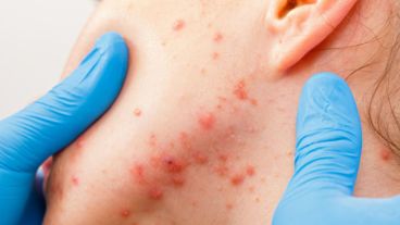 Identificada la causa que genera el acné, hay diversos tratamientos específicos para combatirlo.