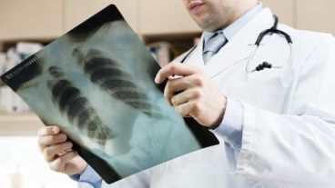 Entre un 10% y un 25% de los casos de cáncer de pulmón se observan en pacientes que nunca fumaron.