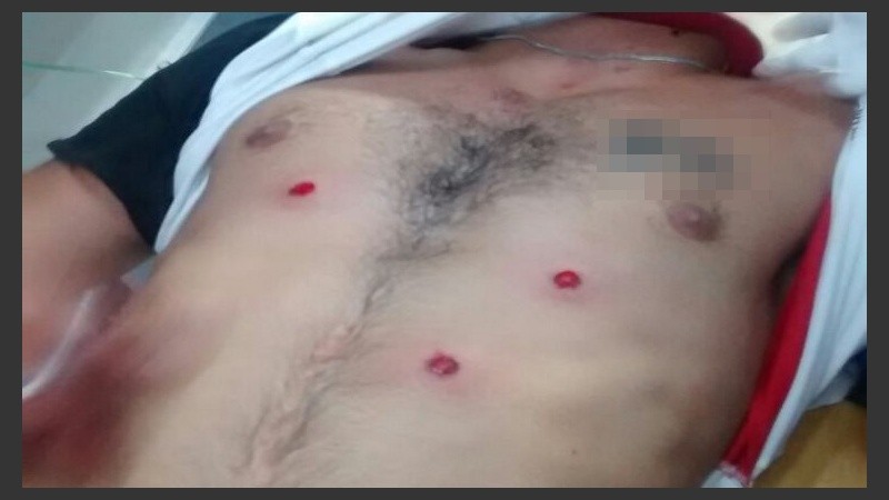 Las heridas de balas de goma. 