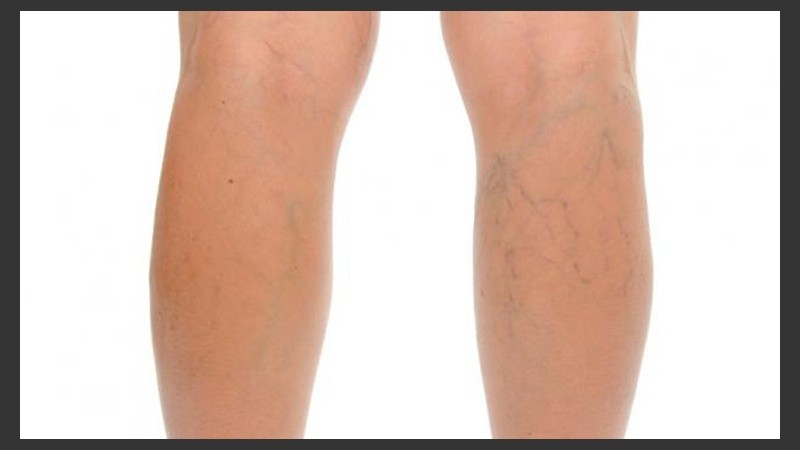 En el país, el 65% de la población presenta várices en miembros inferiores.