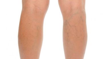 En el país, el 65% de la población presenta várices en miembros inferiores.