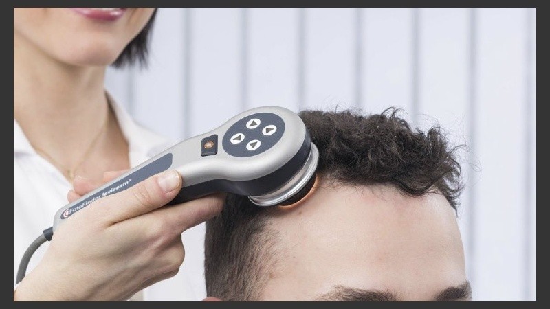 El dermatólogo realiza un diagnóstico inmediato del tipo de alopecia mediante la visualización directa del pelo mediante el tricoscopio.