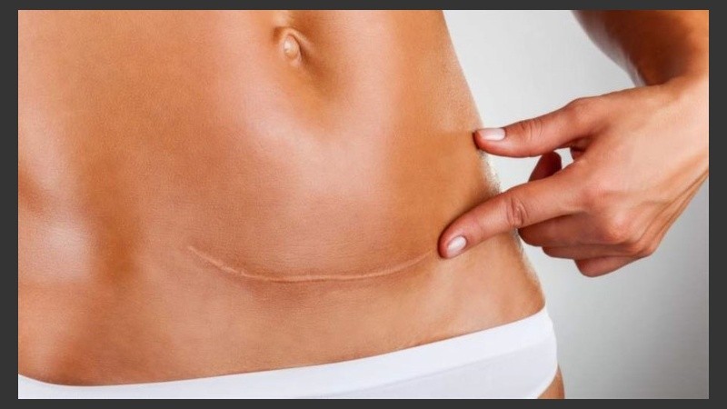 En cicatrices viejas, el uso adecuado de protector solar y crema hidratante son suficientes para cuidar la piel. 