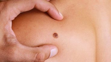 Es fundamental considerar que gran parte de parte de la población con riesgo a desarrollar melanoma es identificable.