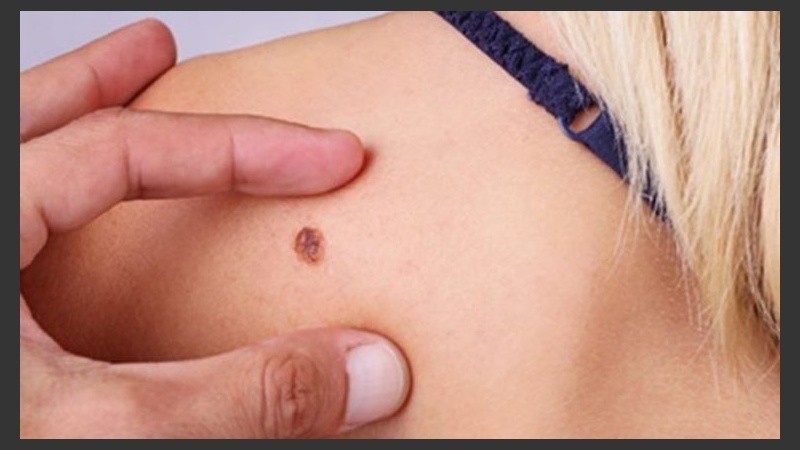 Los melanomas malignos causan la muerte de 55 mil personas cada año.