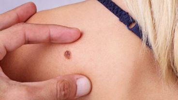 Los melanomas malignos causan la muerte de 55 mil personas cada año.