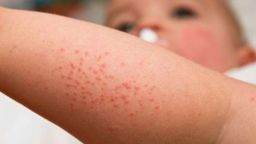 El 80% de los pacientes la padece antes de los dos años.