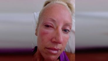 Los médicos explicaron a la mujer de 30 años que el párasito entró en su ojo porque el agua de la ducha estaba “demasiado caliente”.