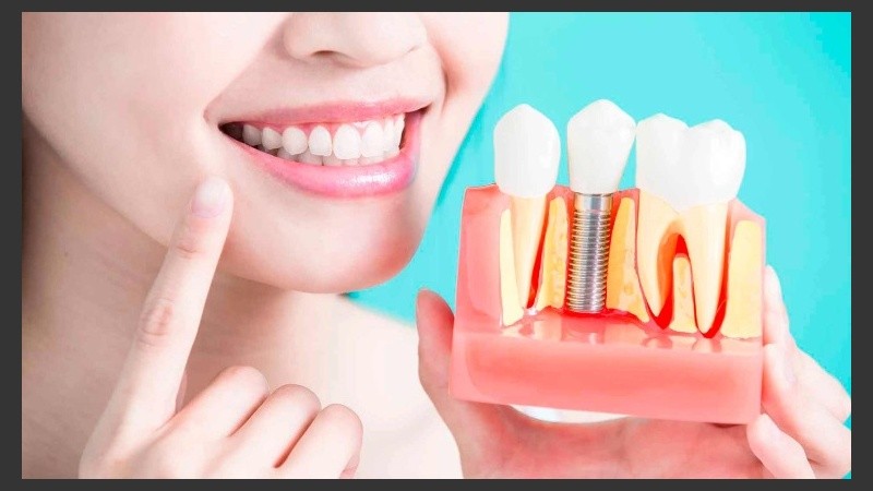 Hay casos en los que no se puede salvar esa pieza afectada; para lo cual el implante es una solución necesaria.